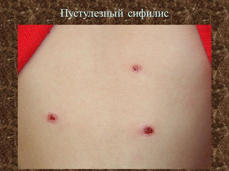 Пустулезный сифилис